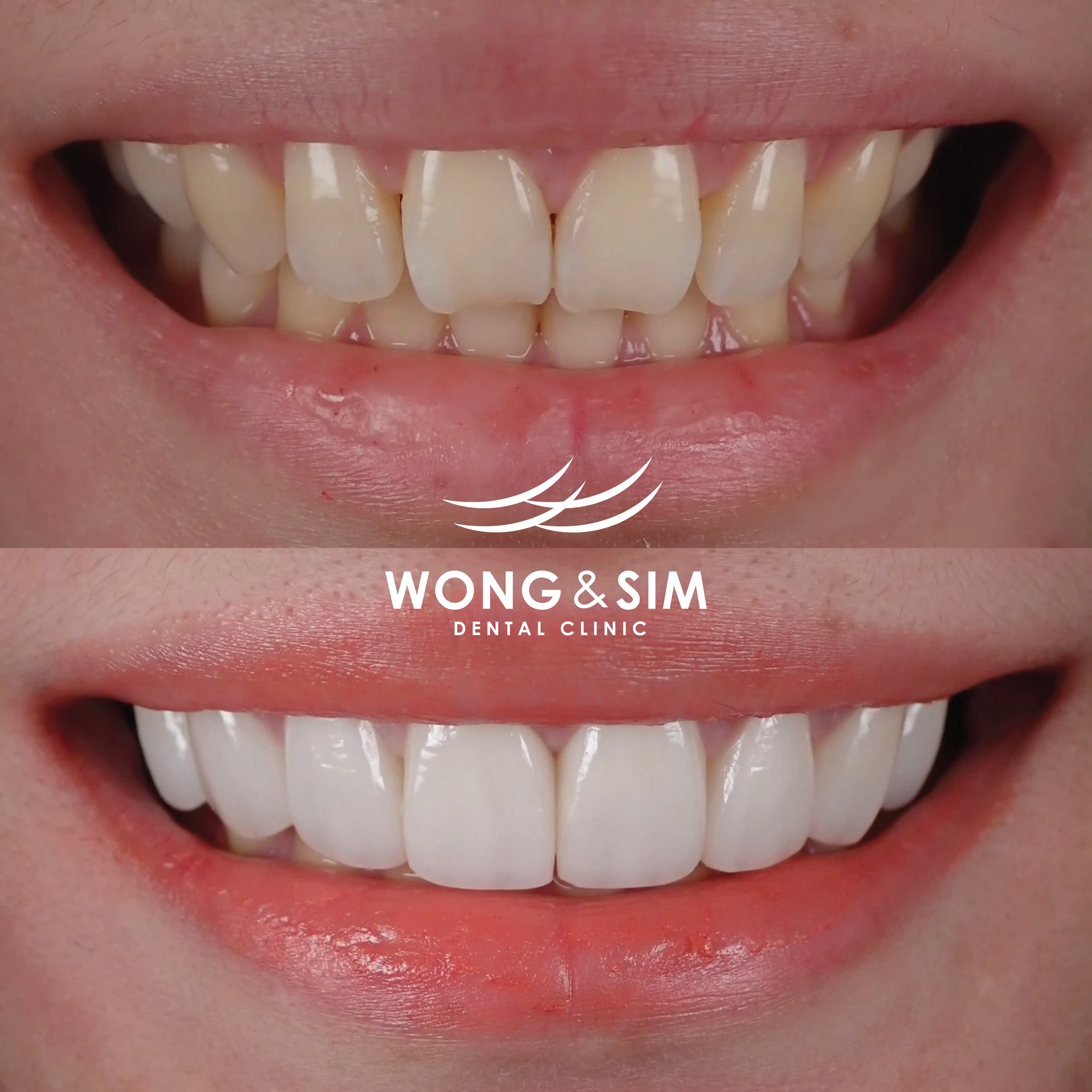 Patient 10 - Veneers Before and After